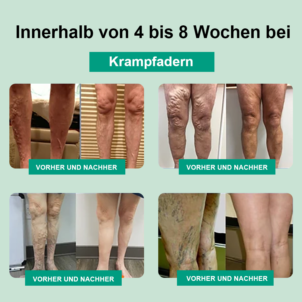 𝑩𝙇𝑼𝑬𝑺𝙃𝑶𝑻® 𝗥𝗮𝗱𝗶𝗼𝗳𝐫𝐞𝗾𝘂𝗲𝗻𝘇-𝗞𝗿ä𝘂𝐭𝐞𝗿-𝗧𝗵𝗲𝗿𝐦𝗼-𝗞𝗻𝗶𝗲𝘀𝗰𝐡𝗼𝗻𝗲𝐫 🍥(Hohe Beinstulpen bei chronischer Veneninsuffizienz, Besenreisern und Schwellungen)🍥